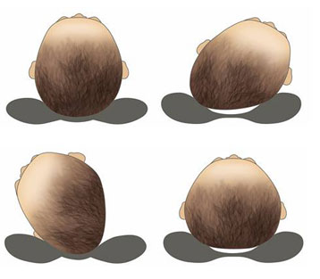 Baby head clearance shape correction pillow